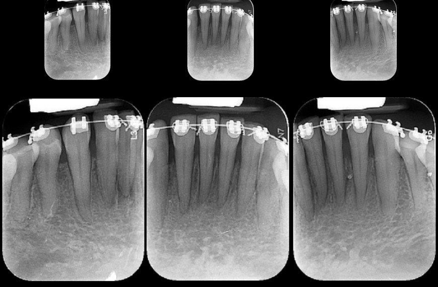 Periapical Individual